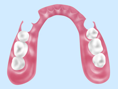 ハイブリッドデンチャー（ノンクラスプデンチャー）