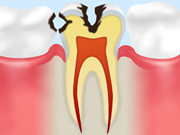 【画像】C2（象牙質（ぞうげしつ）の虫歯）