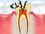 【画像】C3（神経の虫歯）